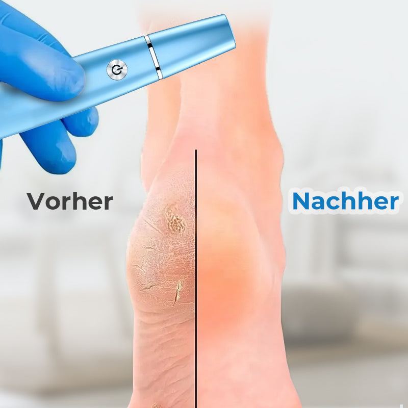 🦶⚡ Elektrischer Hornhautentferner – Sanfte, effektive Fußpflege für glatte Haut ohne Anstrengung! ✨😌